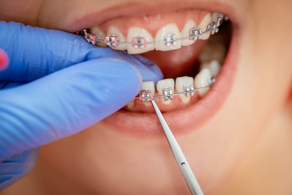 a close up of dental hygienist picking braces