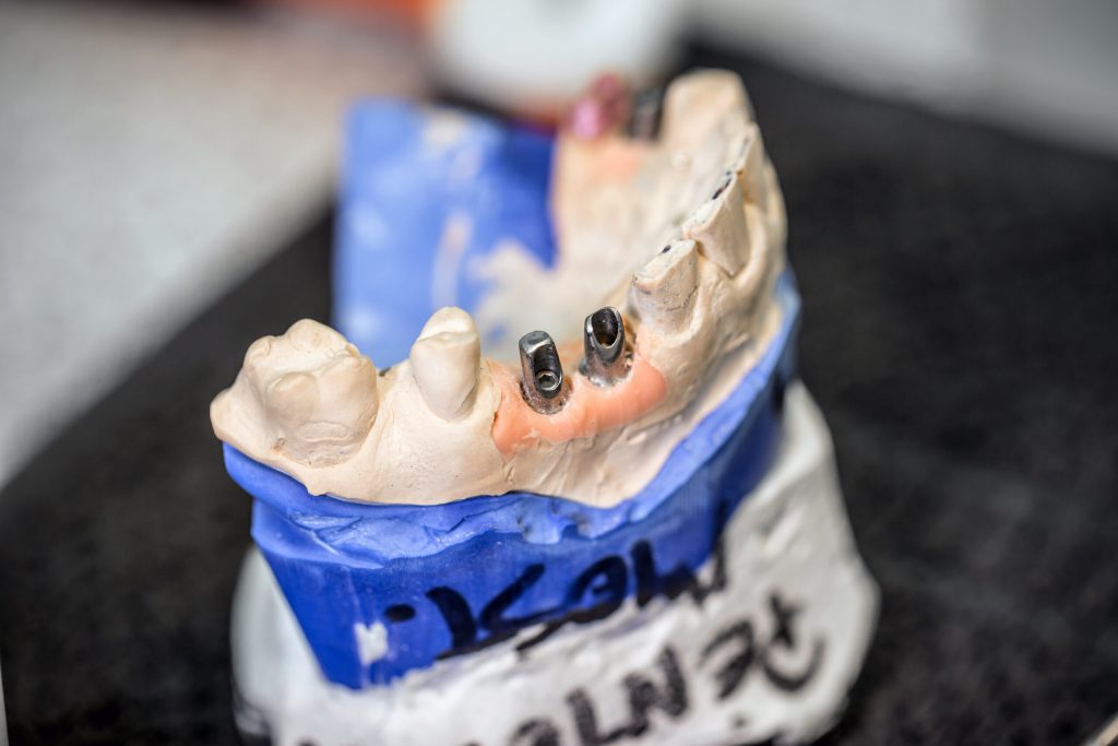 dental implants model