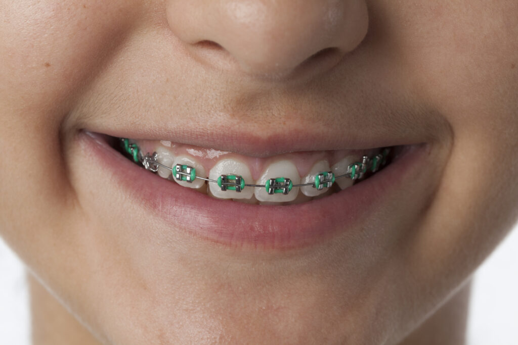 close up of dental braces in the mouth of a child