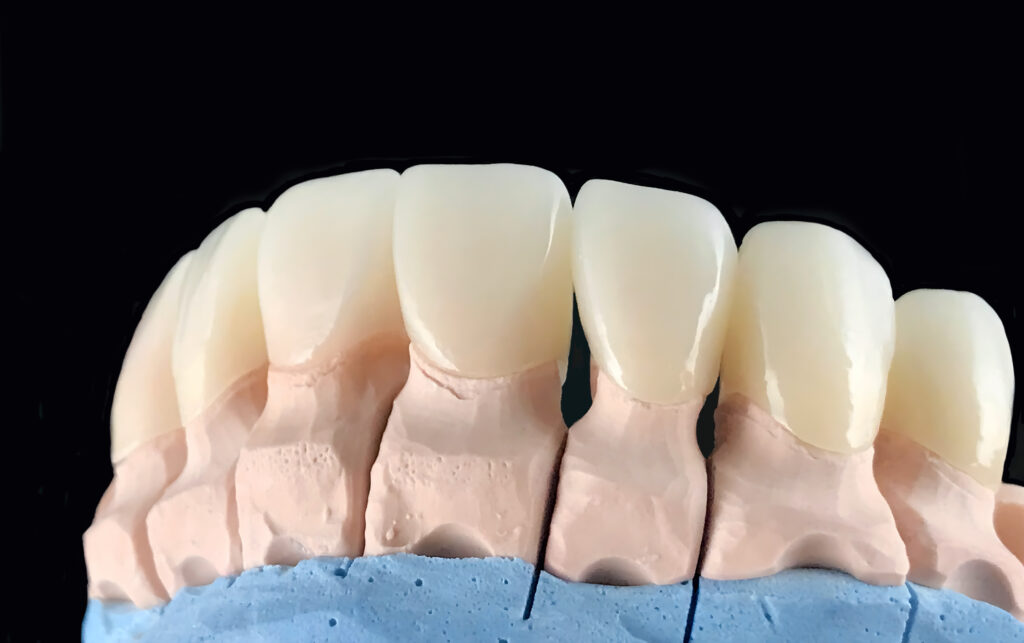 close up of ceramic veneers on dental plaster model