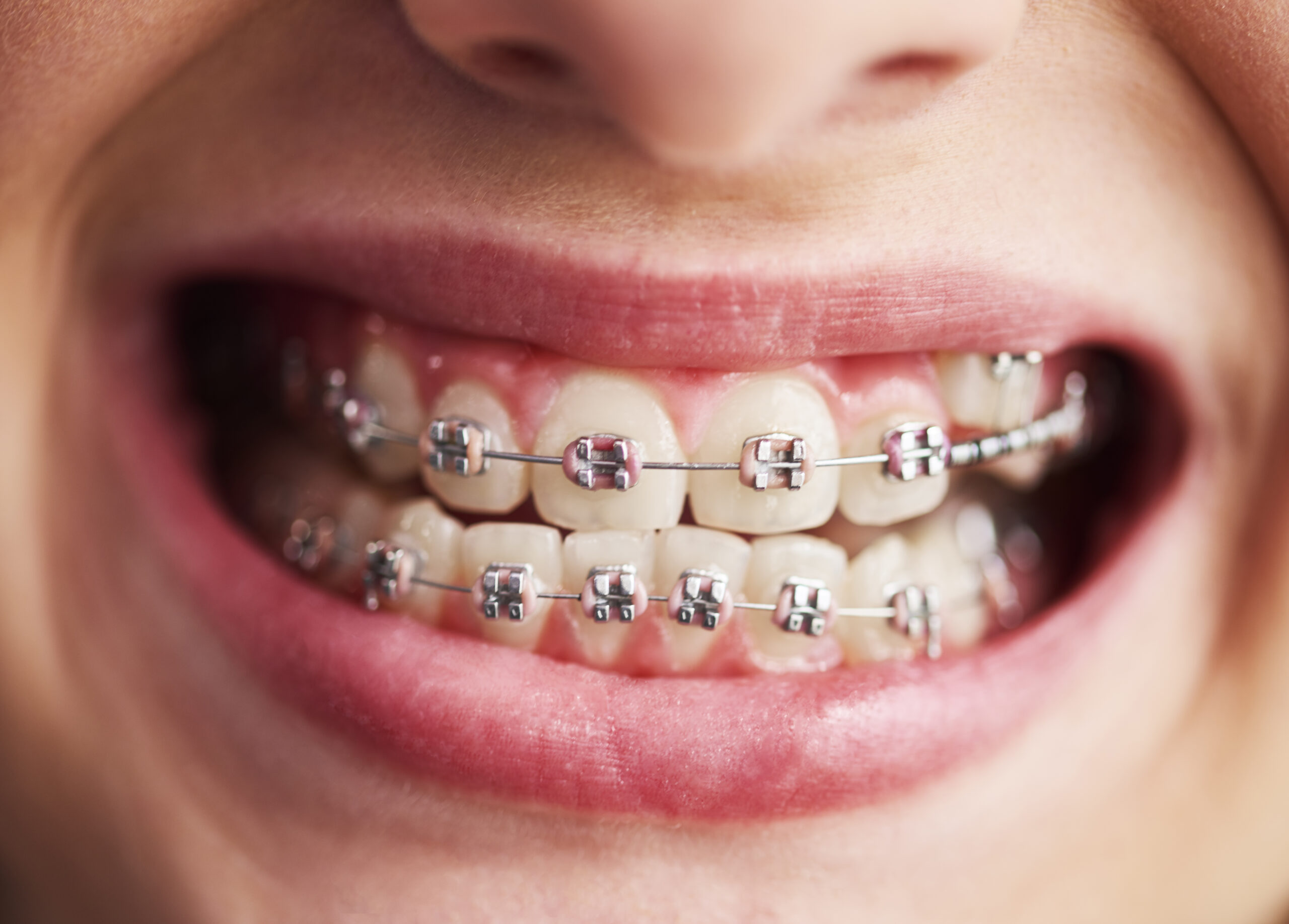 How To Avoid Pain With Braces