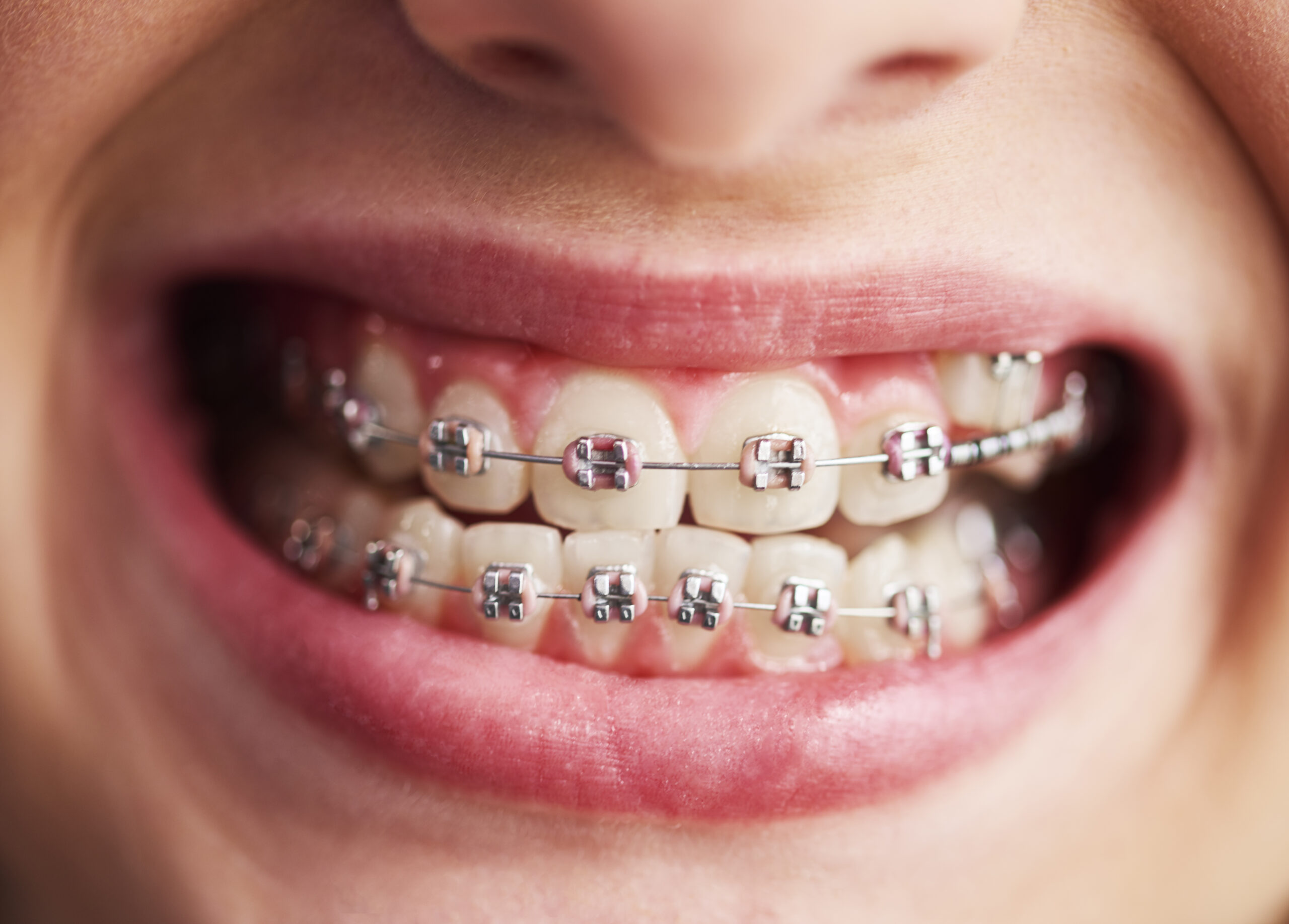 closeup of childs teeth with braces
