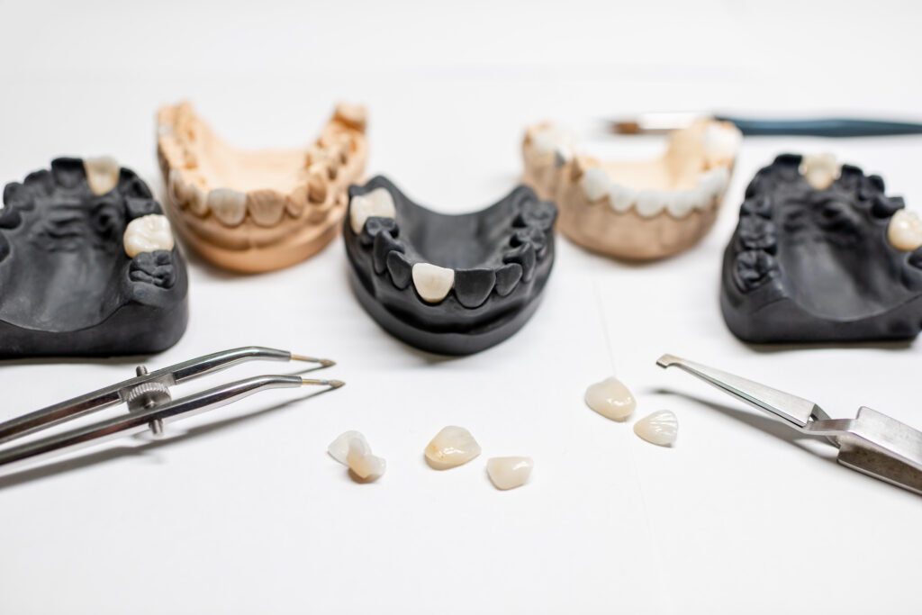 close up of jaw models with veneers