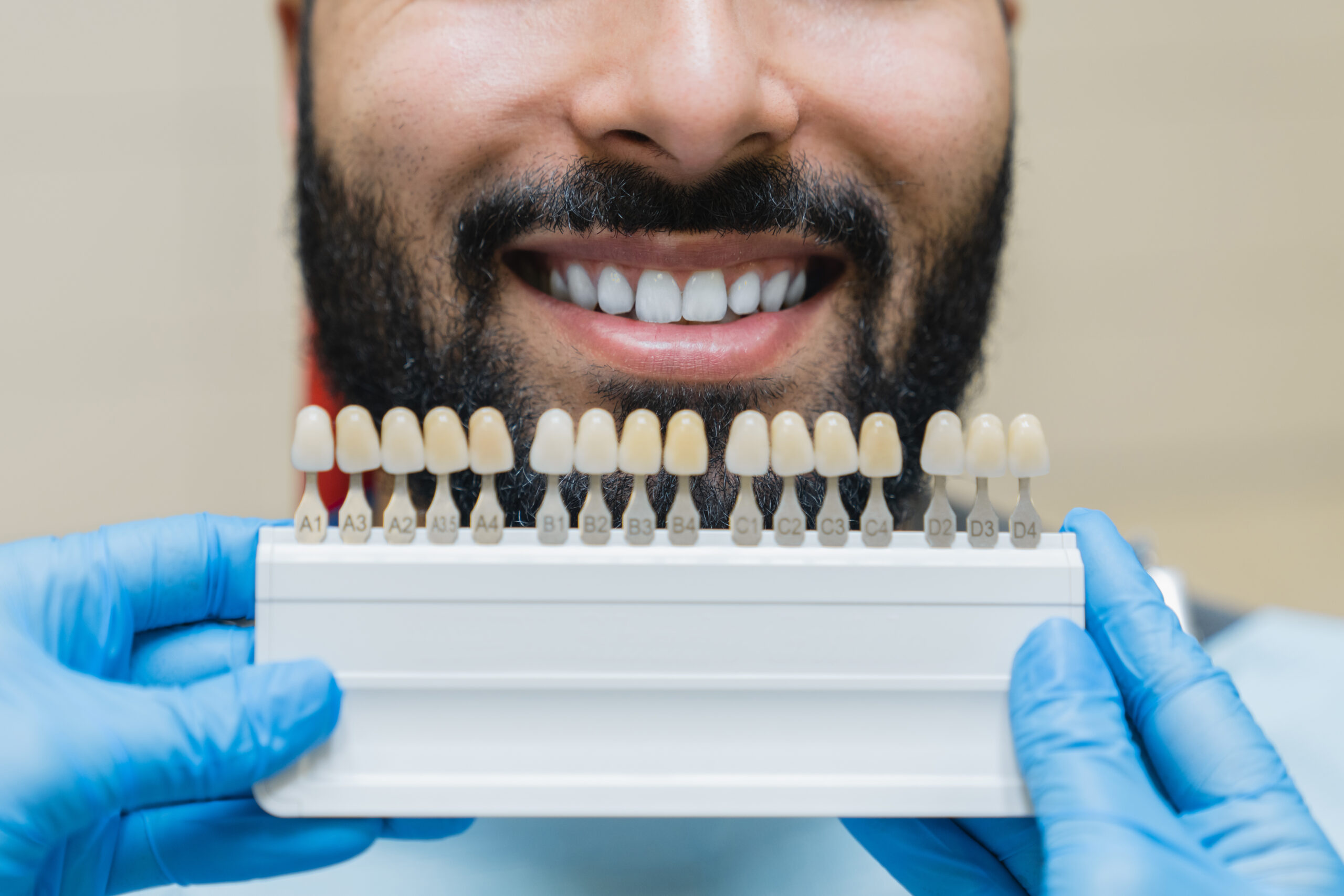 Can Veneers Replace Missing Teeth?