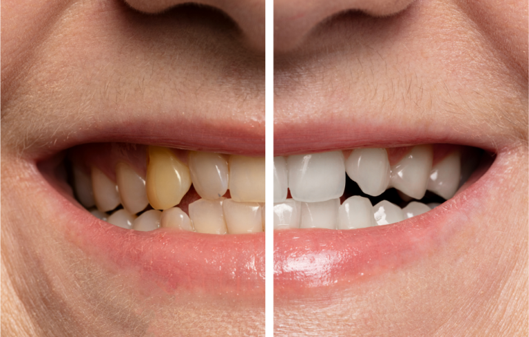 A conjoined, splitscreen image showing yellow teeth next to whitened teeth within the same mouth