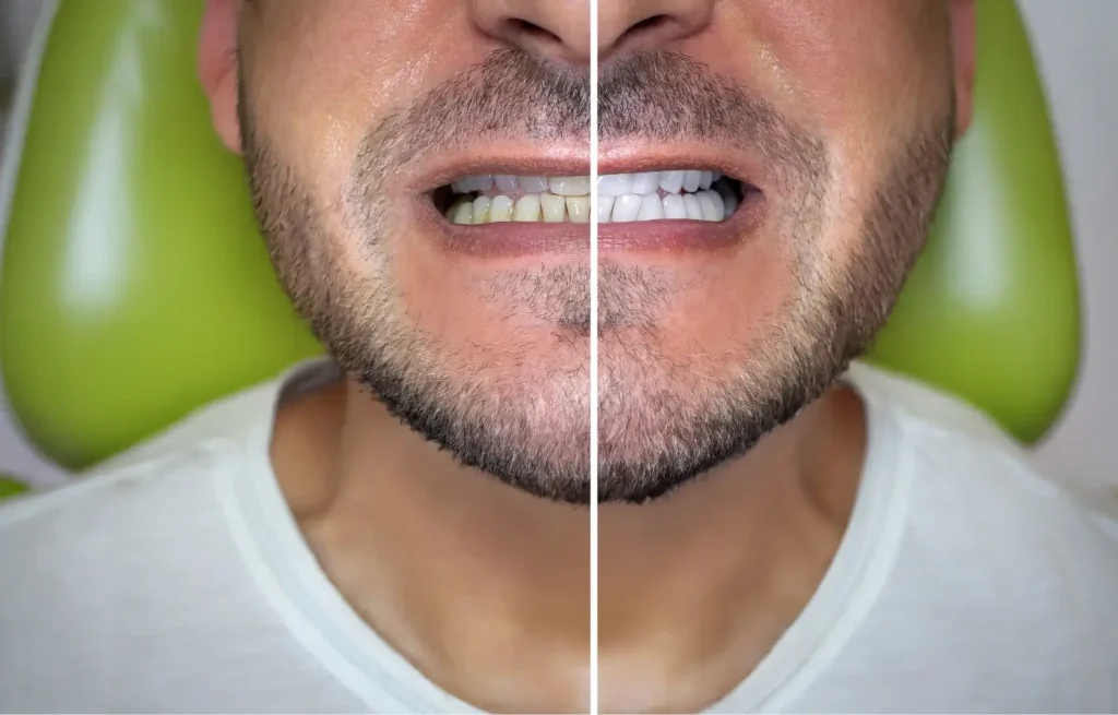 teeth discoloration from vaping