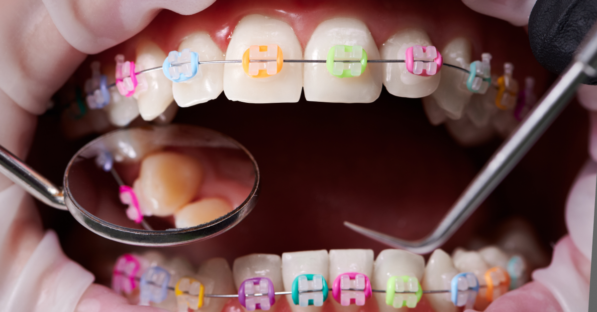 What Are the Best Braces Colors?
