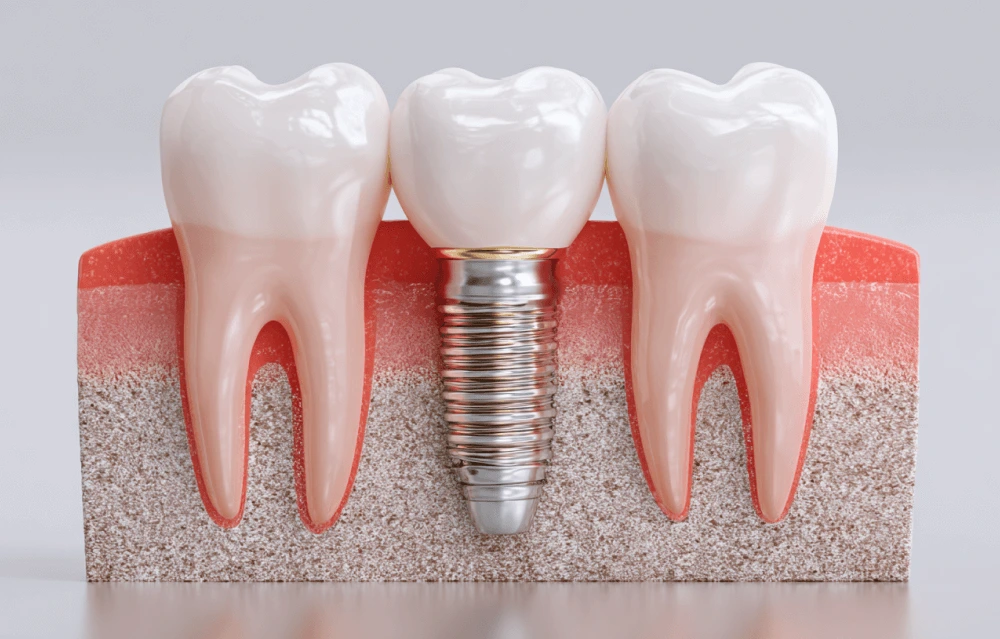 a diagram of a dental implant
